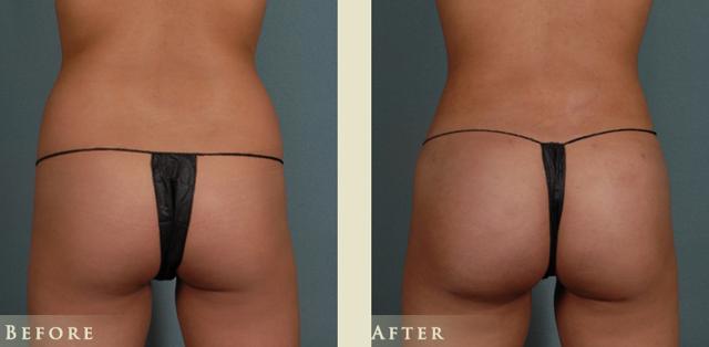 Brazilian Butt Lift result at Colorado Plastic Surgery in Denver, CO