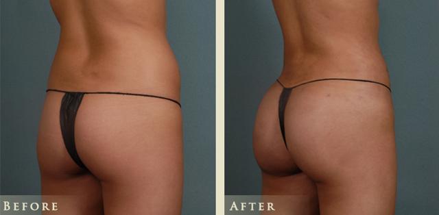 Brazilian Butt Lift result at Colorado Plastic Surgery in Denver, CO