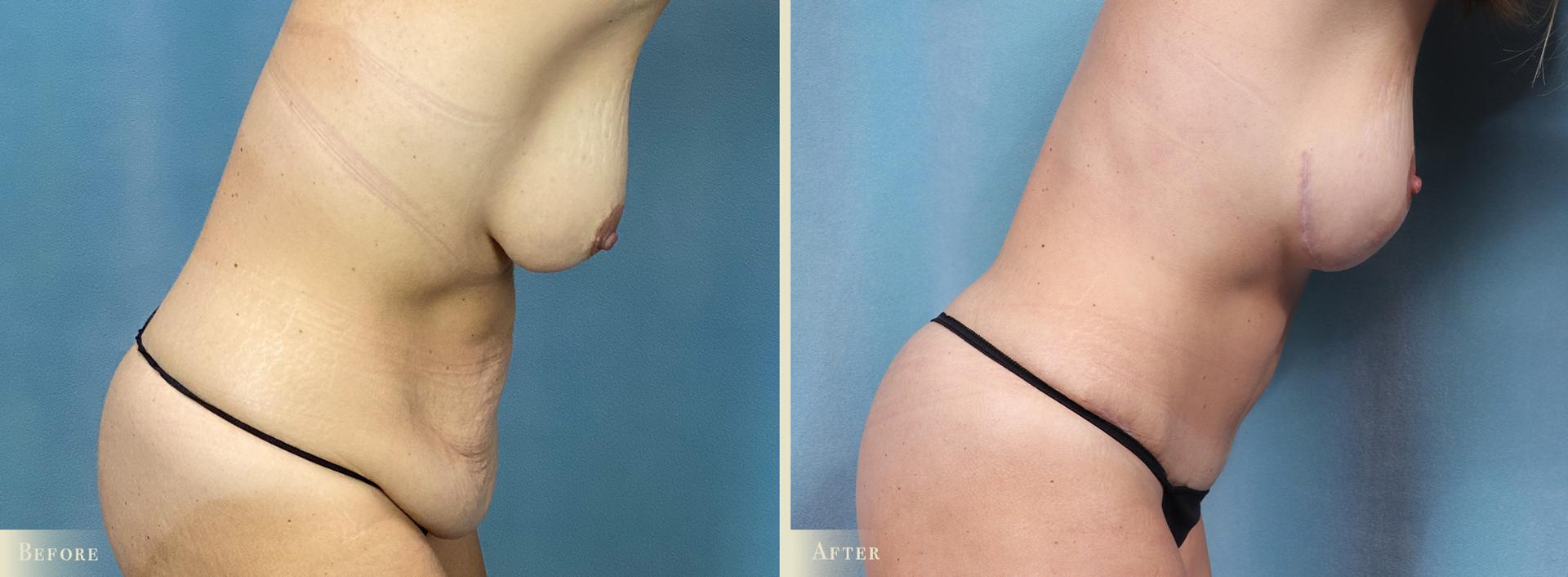 Colorado Plastic Surgery tummy tuck result — Denver, CO