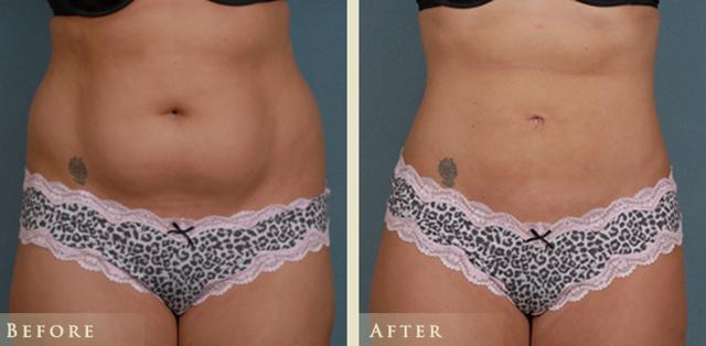 Liposuction result at Colorado Plastic Surgery in Denver, CO