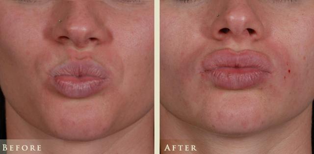Botox result at Colorado Plastic Surgery in Denver, CO