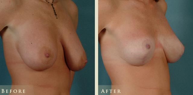 Breast Lift result at Colorado Plastic Surgery in Denver, CO