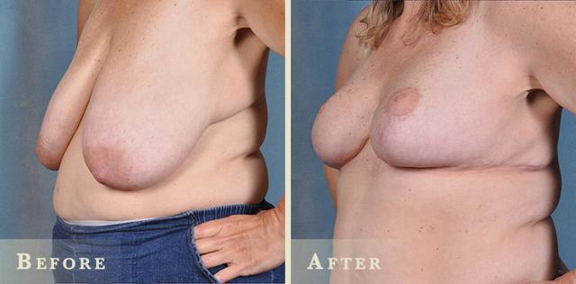 Breast Reduction result at Colorado Plastic Surgery in Denver, CO