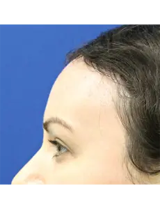 Brow Lift after at Mardirossian Facial Aesthetics in McLean, VA