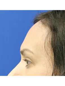 Brow Lift before at Mardirossian Facial Aesthetics in McLean, VA