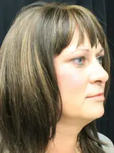 Mardirossian Facial Aesthetics after — McLean, VA