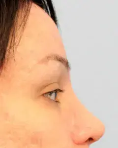 Brow Lift after at Mardirossian Facial Aesthetics in McLean, VA
