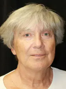 Mini Facelift before at Mardirossian Facial Aesthetics in McLean, VA