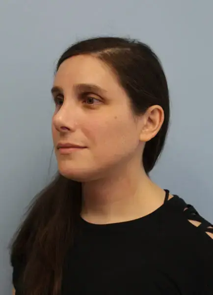 Rhinoplasty after at Mardirossian Facial Aesthetics in McLean, VA