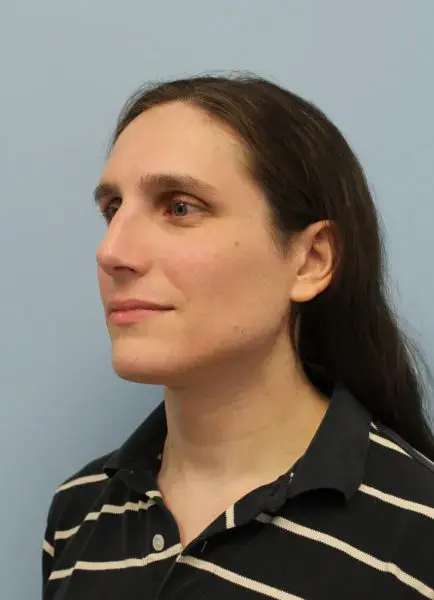 Rhinoplasty before at Mardirossian Facial Aesthetics in McLean, VA