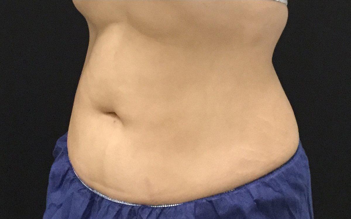 Medical Aesthetics of Virginia coolsculpting after — Norfolk, VA