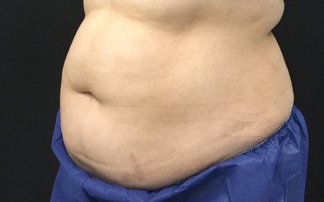 CoolSculpting before at Medical Aesthetics of Virginia in Norfolk, VA