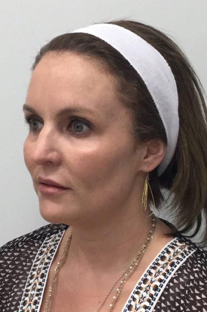 Medical Aesthetics of Virginia after — Norfolk, VA