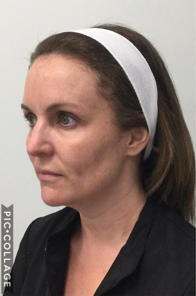 CoolSculpting before at Medical Aesthetics of Virginia in Norfolk, VA