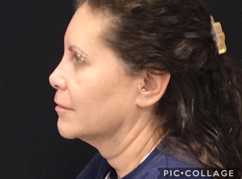 Medical Aesthetics of Virginia coolsculpting after — Norfolk, VA