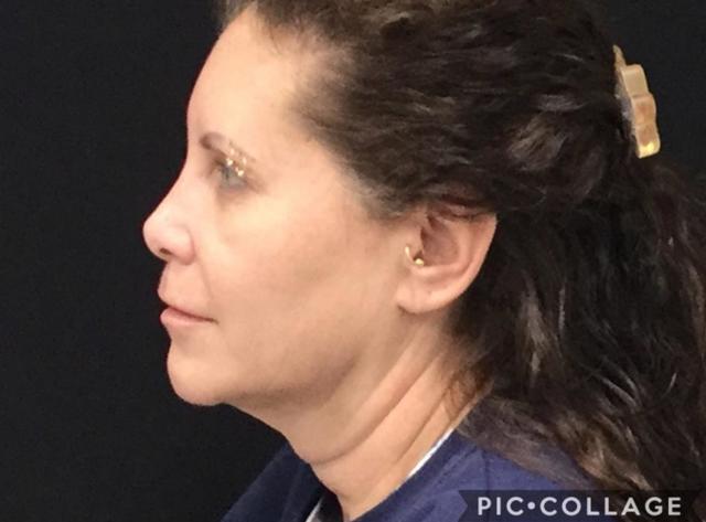 CoolSculpting after at Medical Aesthetics of Virginia in Norfolk, VA