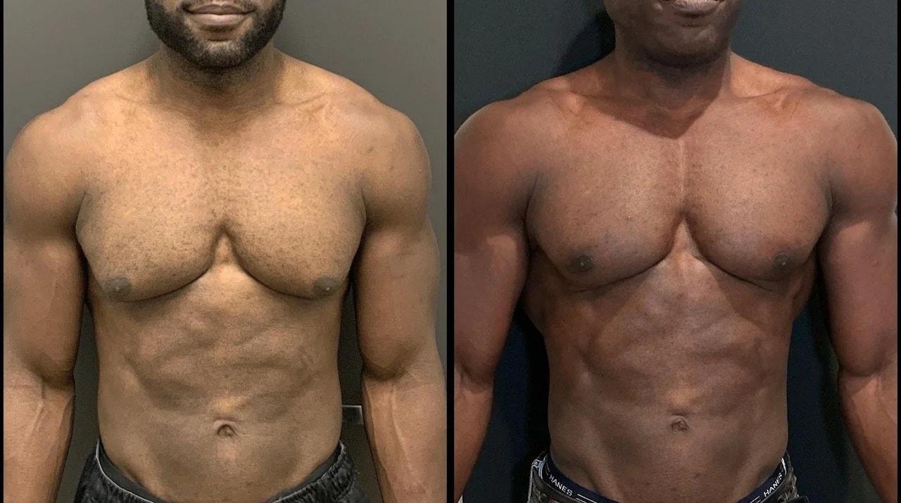 Charlie Chen, MD gynecomastia result — San Diego, CA