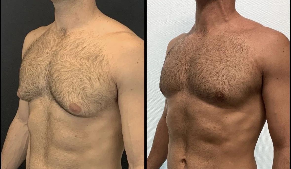 Charlie Chen, MD gynecomastia result — San Diego, CA