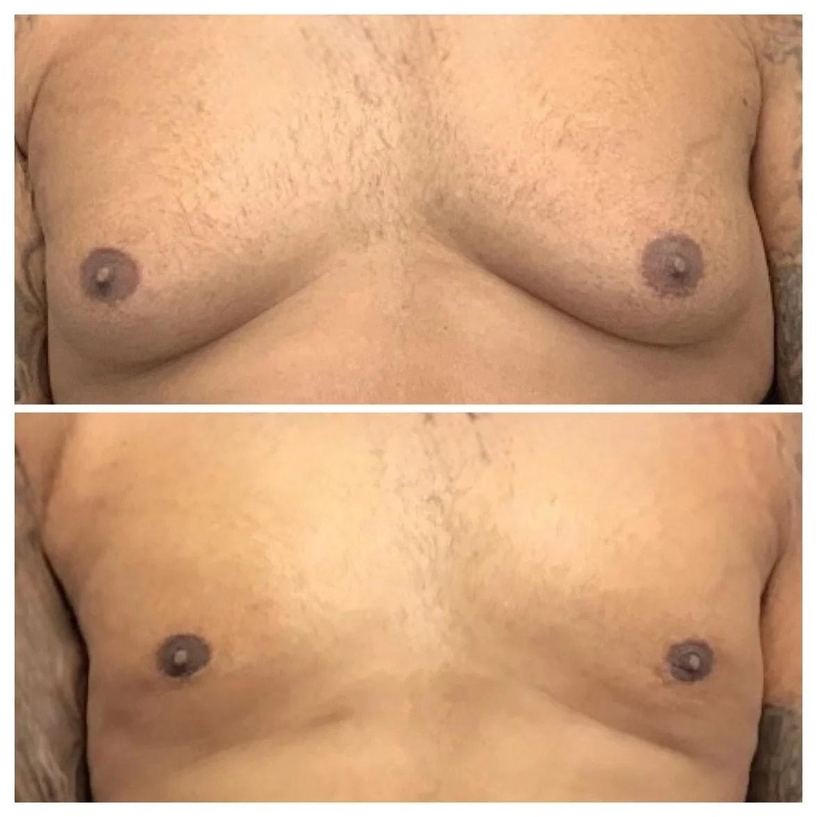 Charlie Chen, MD gynecomastia result — San Diego, CA
