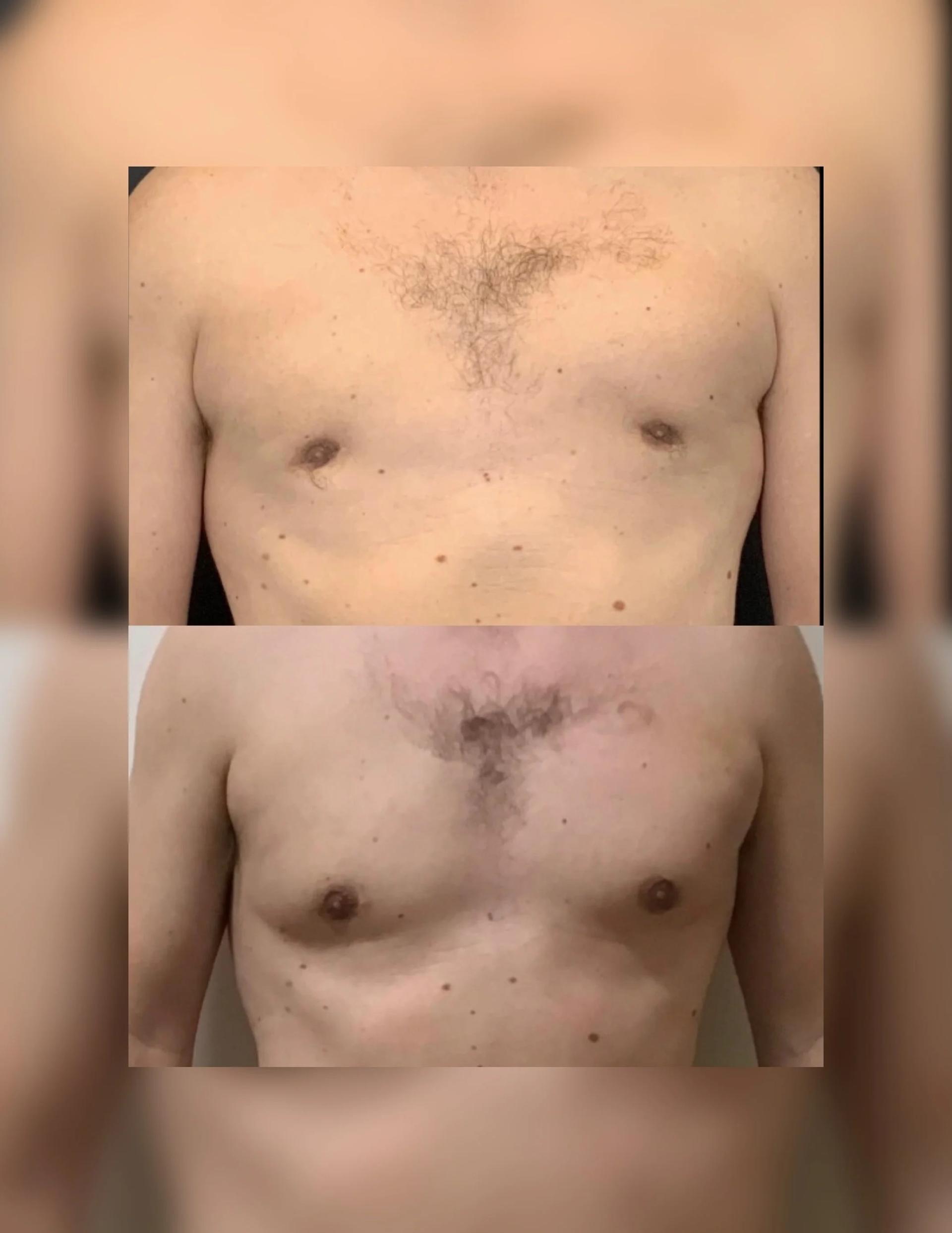Charlie Chen, MD gynecomastia result — San Diego, CA