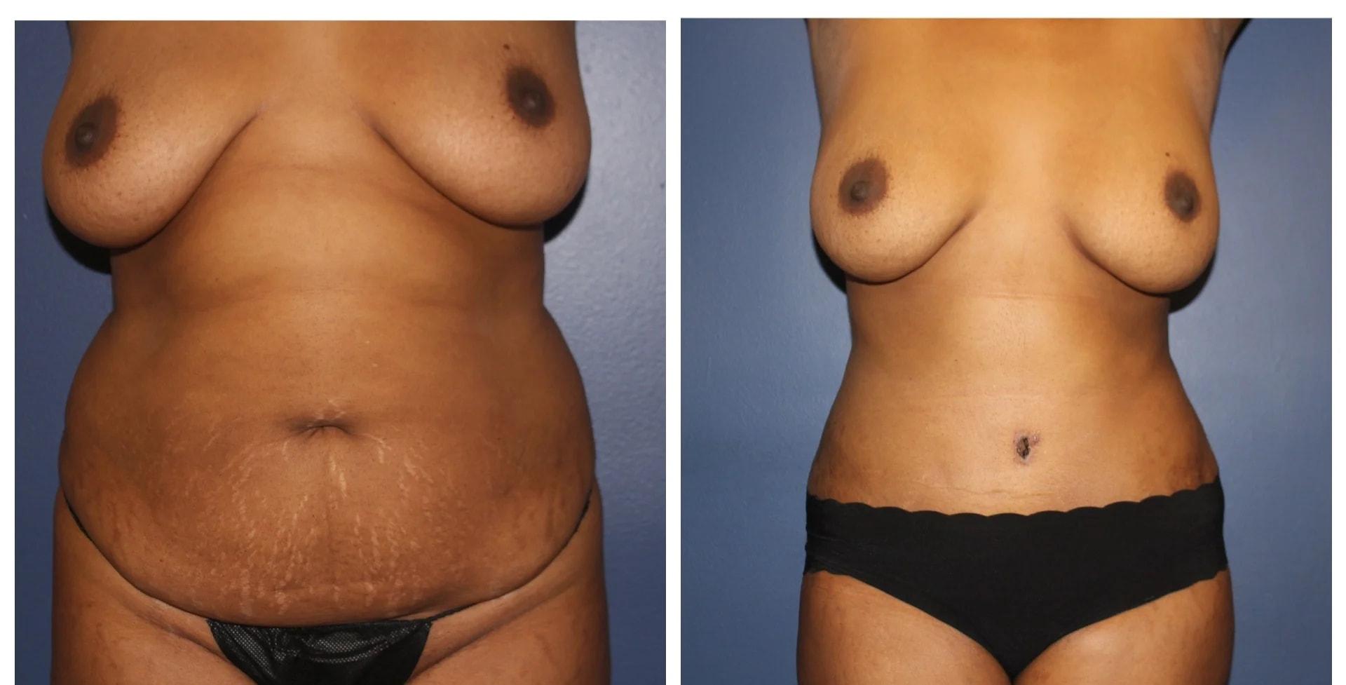 Charlie Chen, MD mommy makeover result — San Diego, CA