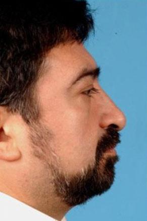 John Vartanian, MD rhinoplasty after — Glendale, CA