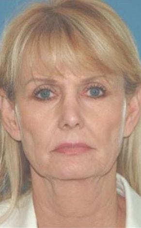 Deep Plane Facelift before at John Vartanian, MD in Glendale, CA
