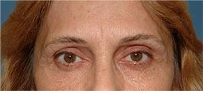 Blepharoplasty after at John Vartanian, MD in Glendale, CA