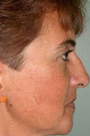 Rhinoplasty before at John Vartanian, MD in Glendale, CA