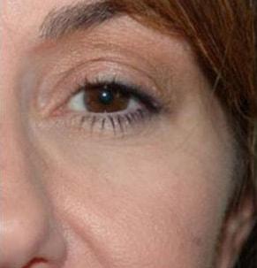 John Vartanian, MD under-eye filler after — Glendale, CA