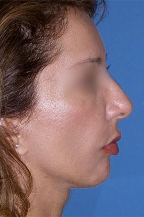 Deep Plane Facelift after at John Vartanian, MD in Glendale, CA