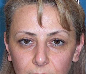 Blepharoplasty before at John Vartanian, MD in Glendale, CA