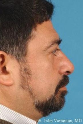 Rhinoplasty before at John Vartanian, MD in Glendale, CA