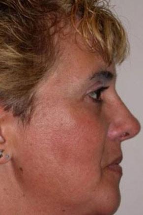 John Vartanian, MD rhinoplasty after — Glendale, CA