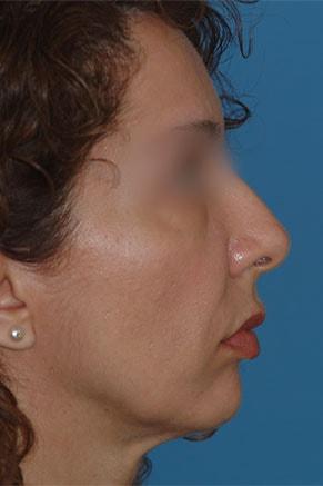 Deep Plane Facelift before at John Vartanian, MD in Glendale, CA