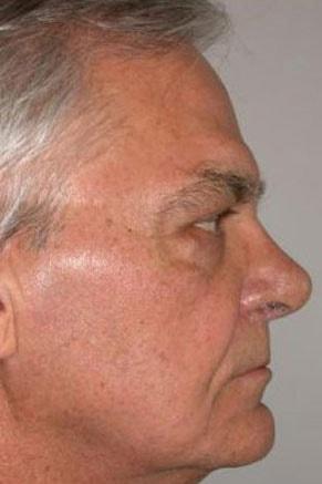 Rhinoplasty after at John Vartanian, MD in Glendale, CA