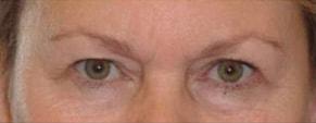 Blepharoplasty before at John Vartanian, MD in Glendale, CA
