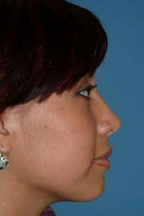 John Vartanian, MD rhinoplasty after — Glendale, CA