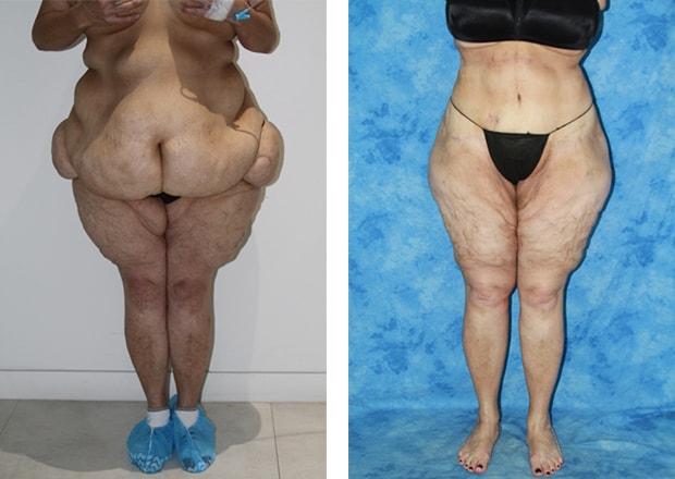 Wendell C. Perry, MD liposuction result — South Miami, FL