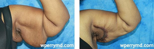 Wendell C. Perry, MD arm lift result — South Miami, FL