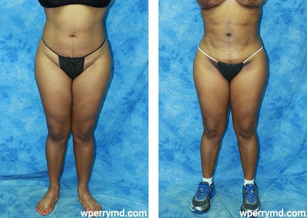 Wendell C. Perry, MD liposuction result — South Miami, FL