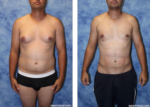 Wendell C. Perry, MD gynecomastia result — South Miami, FL