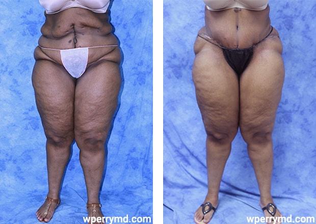 Wendell C. Perry, MD tummy tuck result — South Miami, FL