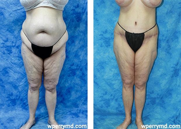 Wendell C. Perry, MD tummy tuck result — South Miami, FL