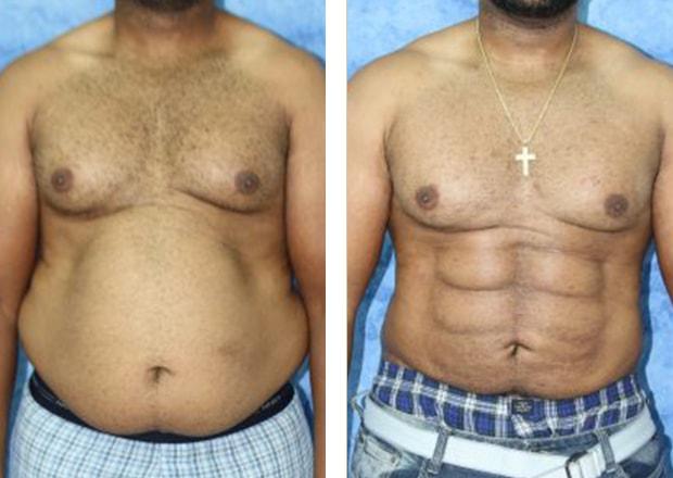 Wendell C. Perry, MD liposuction result — South Miami, FL