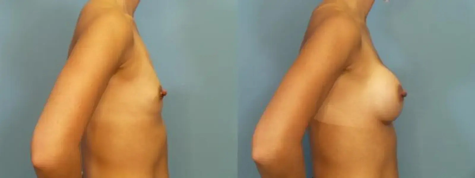 Portland Plastic Surgery Group breast augmentation result — Portland, OR