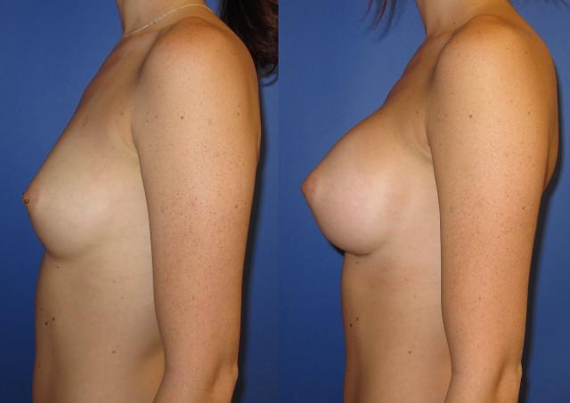 Breast Augmentation result at Portland Plastic Surgery Group in Portland, OR