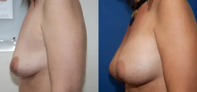 Fat Transfer Breast Augmentation result at Portland Plastic Surgery Group in Portland, OR