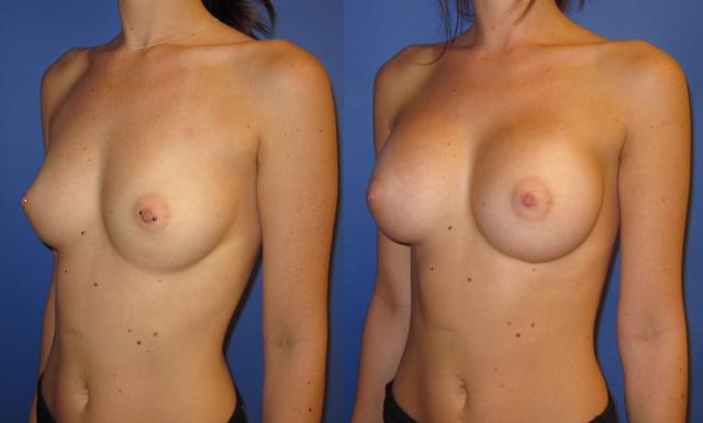 Breast Augmentation result at Portland Plastic Surgery Group in Portland, OR