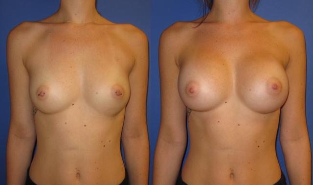Breast Augmentation result at Portland Plastic Surgery Group in Portland, OR